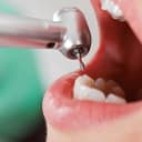 جراحی انتهای ریشه دندان (اپیکو)