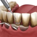 جرم‌گیری عمقی و کورتاژ لثه