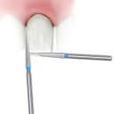 فرم‌دهی مینای دندان (Enameloplasty)
